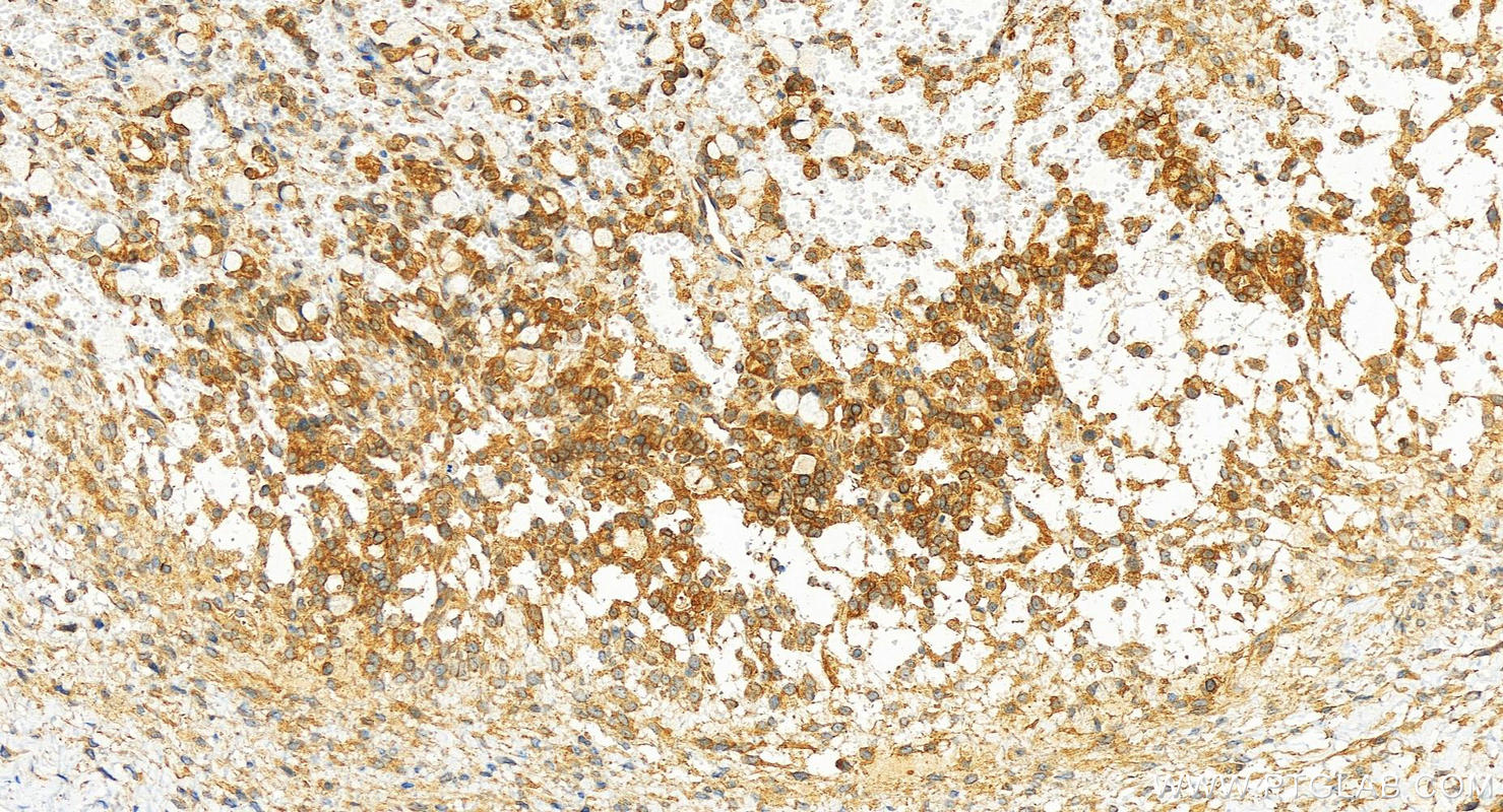 IHC staining of human ovary cancer using 83615-4-RR (same clone as 83615-4-PBS)