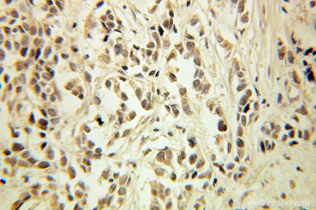IHC staining of human prostate cancer using 10752-1-AP