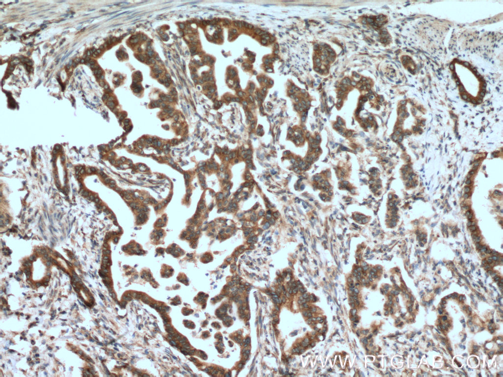 IHC staining of human pancreas cancer using 66173-1-Ig (same clone as 66173-1-PBS)
