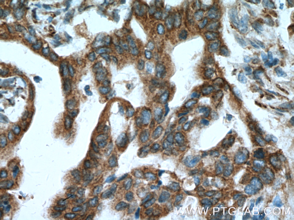 IHC staining of human pancreas cancer using 66173-1-Ig (same clone as 66173-1-PBS)