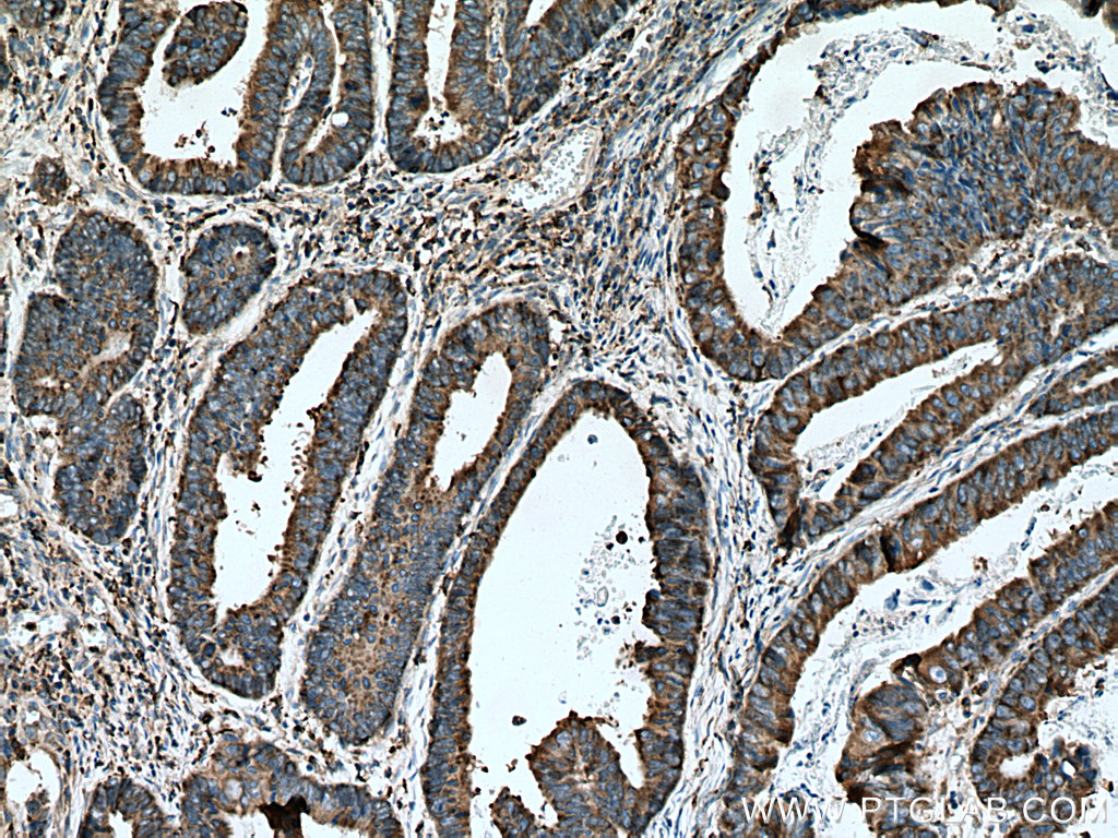 IHC staining of human colon cancer using 15215-1-AP