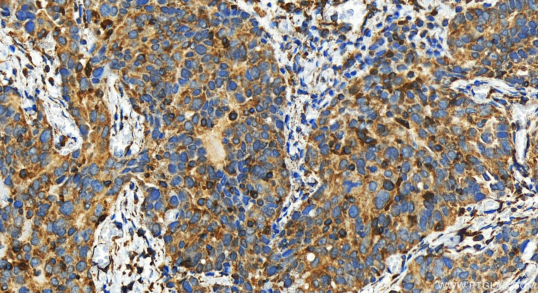 IHC staining of human ovary cancer using 30721-1-AP