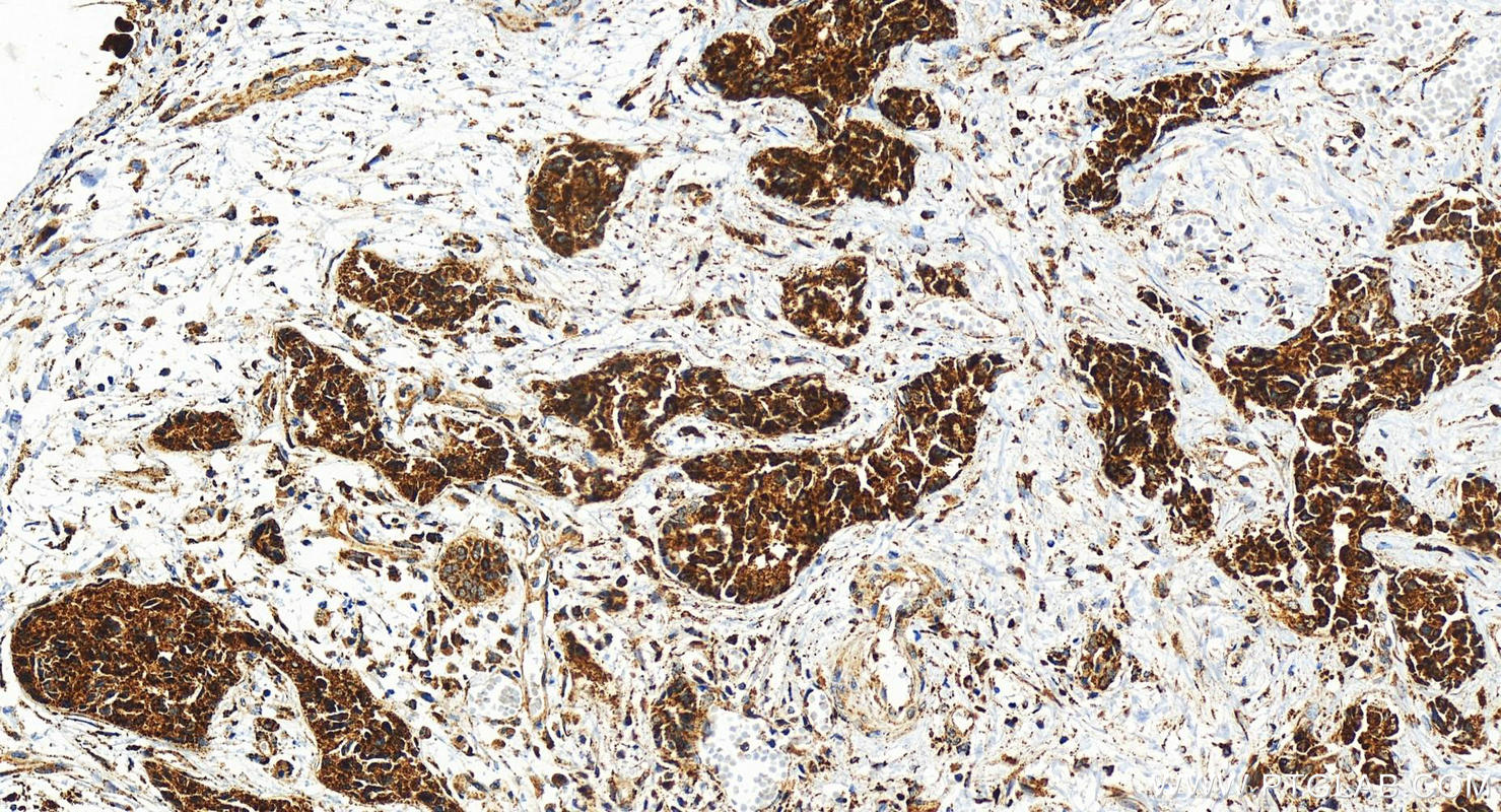 IHC staining of human intrahepatic cholangiocarcinoma using 83326-1-RR