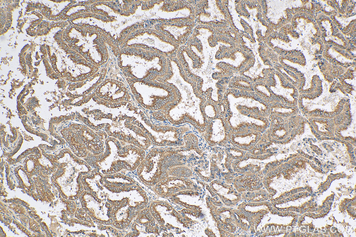 IHC staining of human ovary tumor using 10767-1-AP