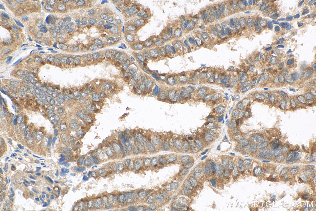 IHC staining of human ovary tumor using 10767-1-AP