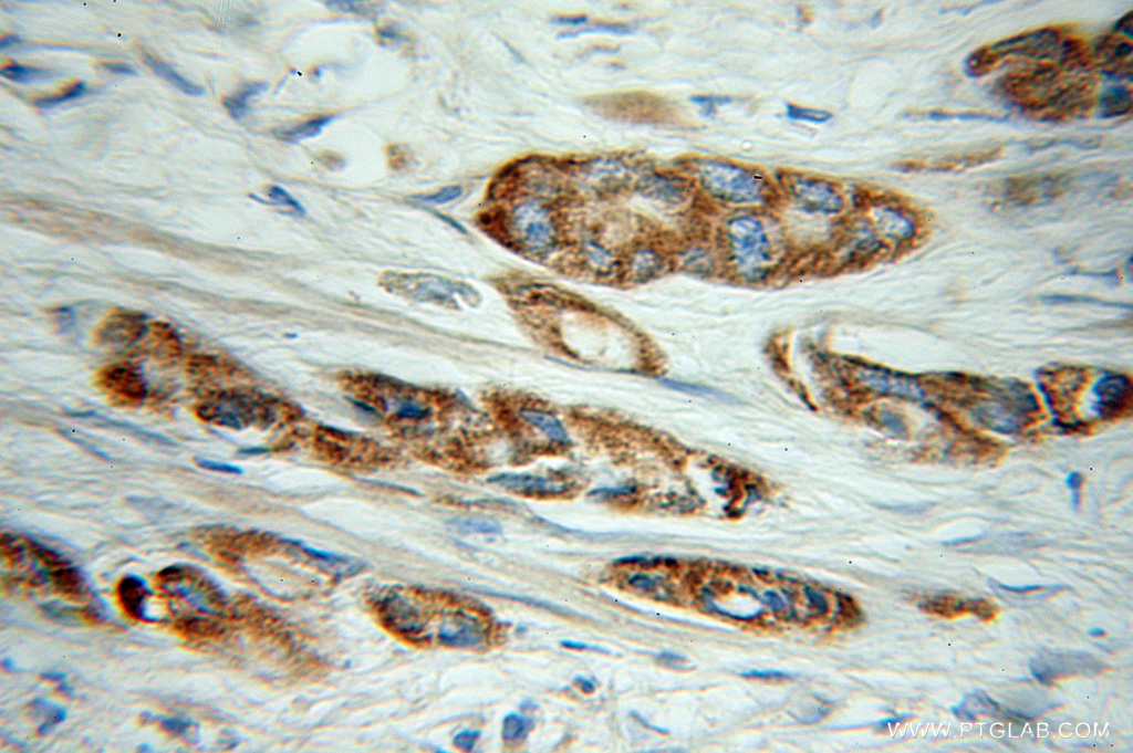 IHC staining of human prostate cancer using 11130-1-AP