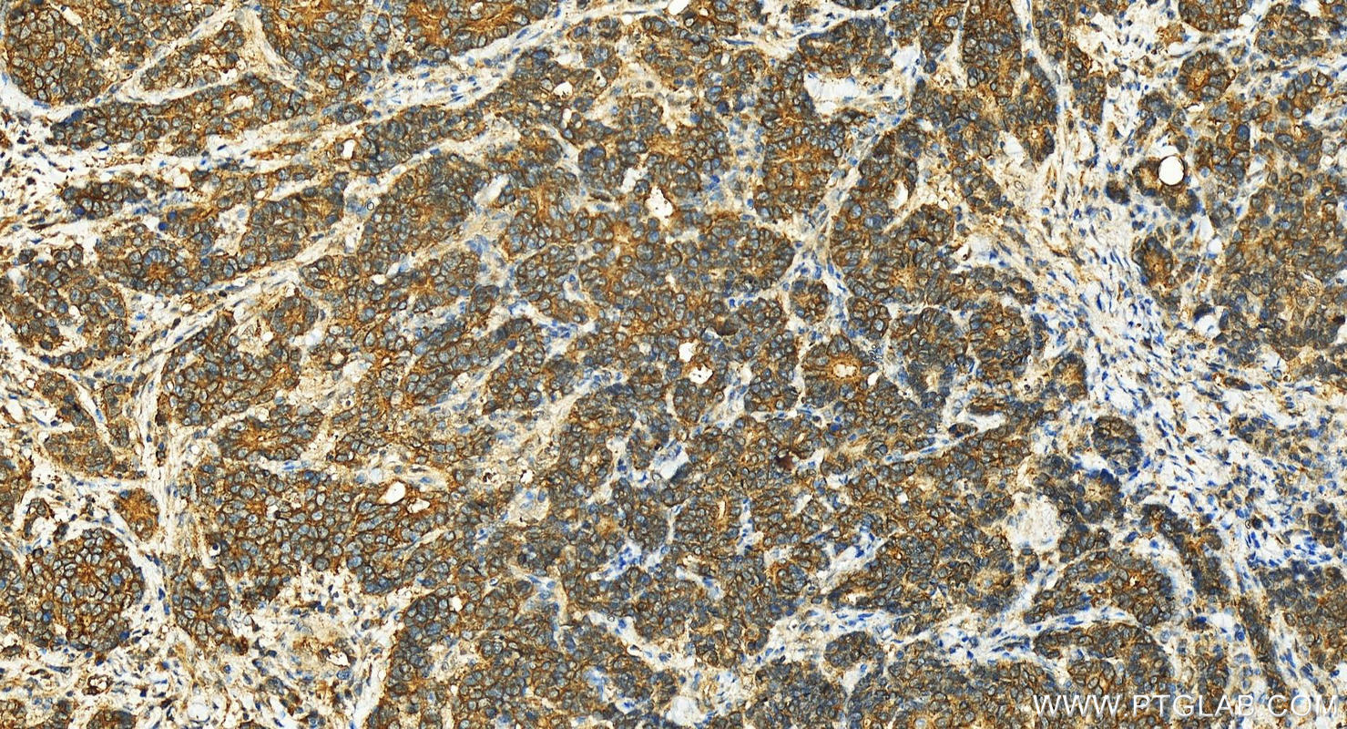 IHC staining of human stomach cancer using 14277-1-AP