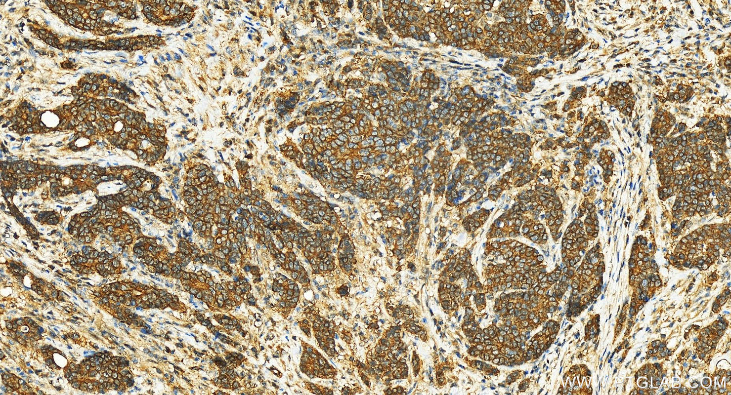 IHC staining of human stomach cancer using 14277-1-AP