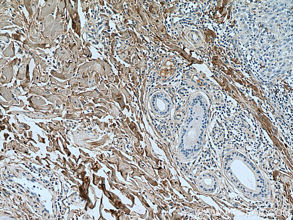 IHC staining of human skin cancer using 14695-1-AP