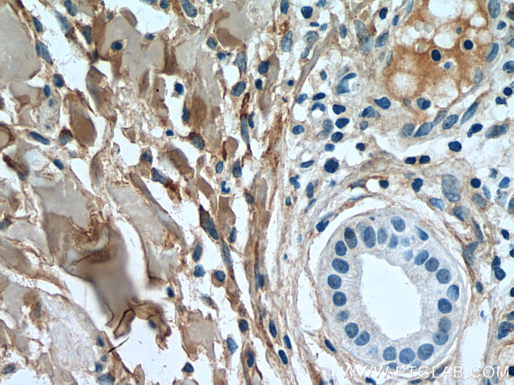 IHC staining of human skin cancer using 14695-1-AP