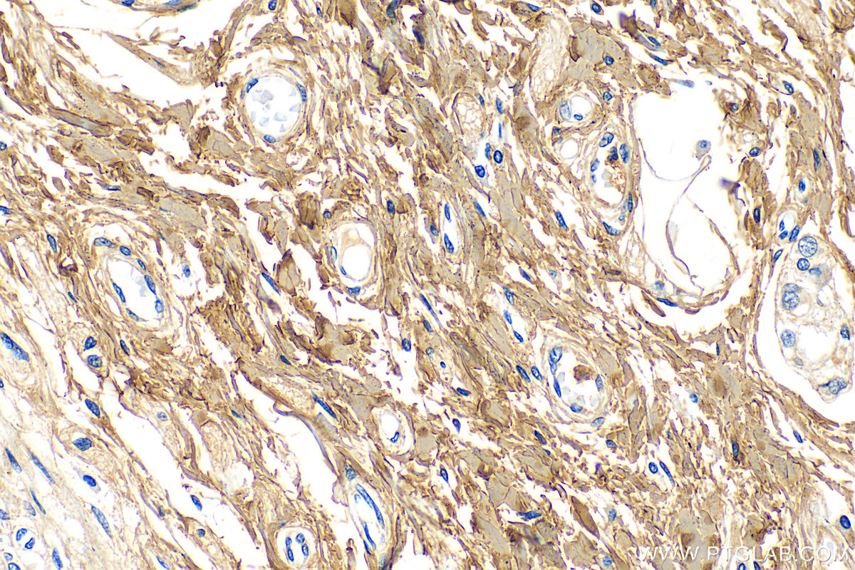 Immunohistochemical analysis of paraffin-embedded human colon tissue slide using 14695-1-AP (Collagen Type I antibody) at dilution of 1:1000 (under 40x lens). Heat mediated antigen retrieval with Tris-EDTA buffer (pH 9.0). IHC staining of human colon using 14695-1-AP