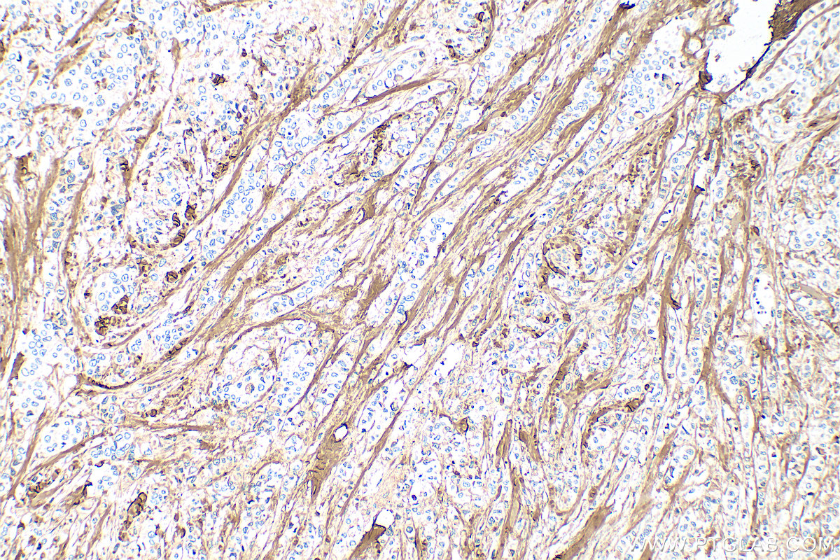 Immunohistochemical analysis of paraffin-embedded human breast cancer tissue slide using 14695-1-AP (Collagen Type I antibody) at dilution of 1:1000 (under 10x lens). Heat mediated antigen retrieval with Tris-EDTA buffer (pH 9.0). IHC staining of human breast cancer using 14695-1-AP
