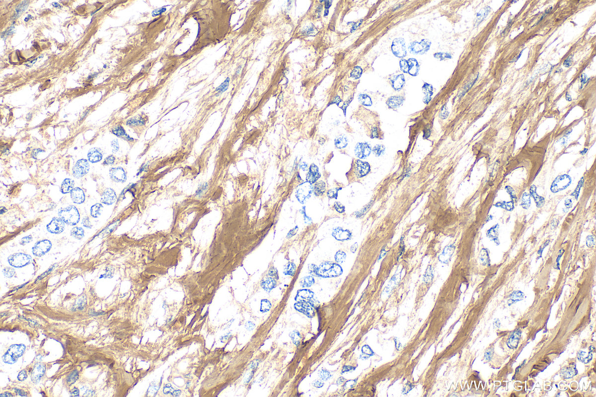 Immunohistochemical analysis of paraffin-embedded human breast cancer tissue slide using 14695-1-AP (Collagen Type I antibody) at dilution of 1:1000 (under 40x lens). Heat mediated antigen retrieval with Tris-EDTA buffer (pH 9.0). IHC staining of human breast cancer using 14695-1-AP
