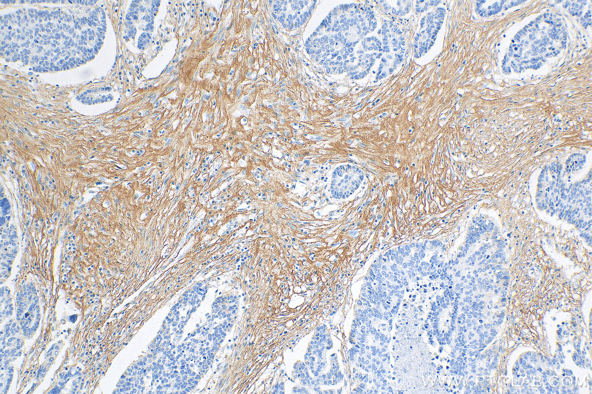 IHC staining of human ovary tumor using 68320-1-Ig