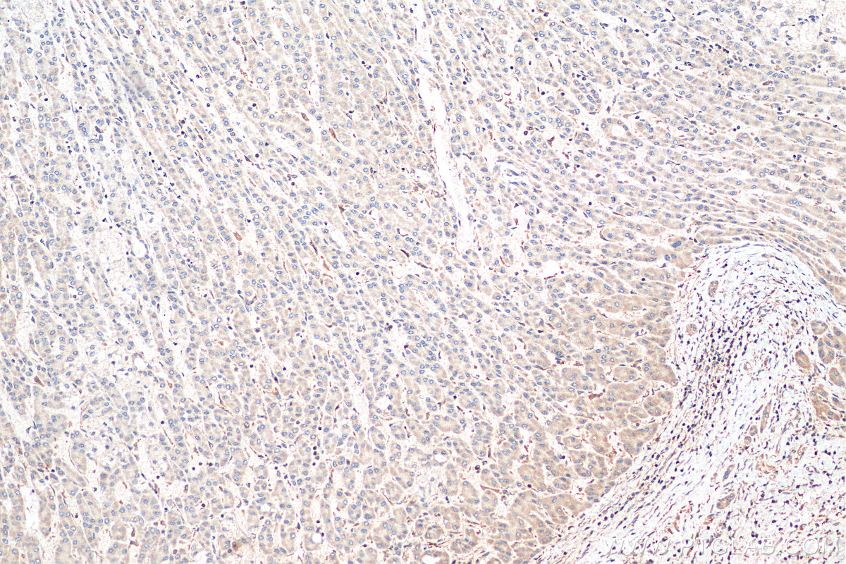 IHC staining of human liver cancer using 11938-1-AP