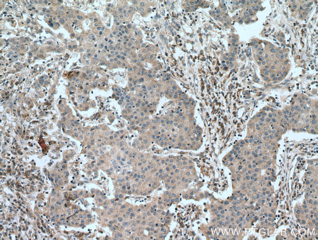 IHC staining of human breast cancer using 67016-1-Ig