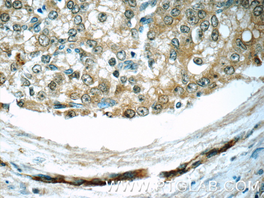 IHC staining of human prostate cancer using 11457-1-AP