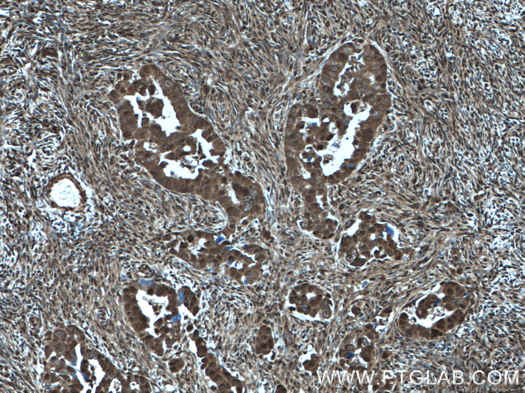 IHC staining of human ovary tumor using 10969-2-AP