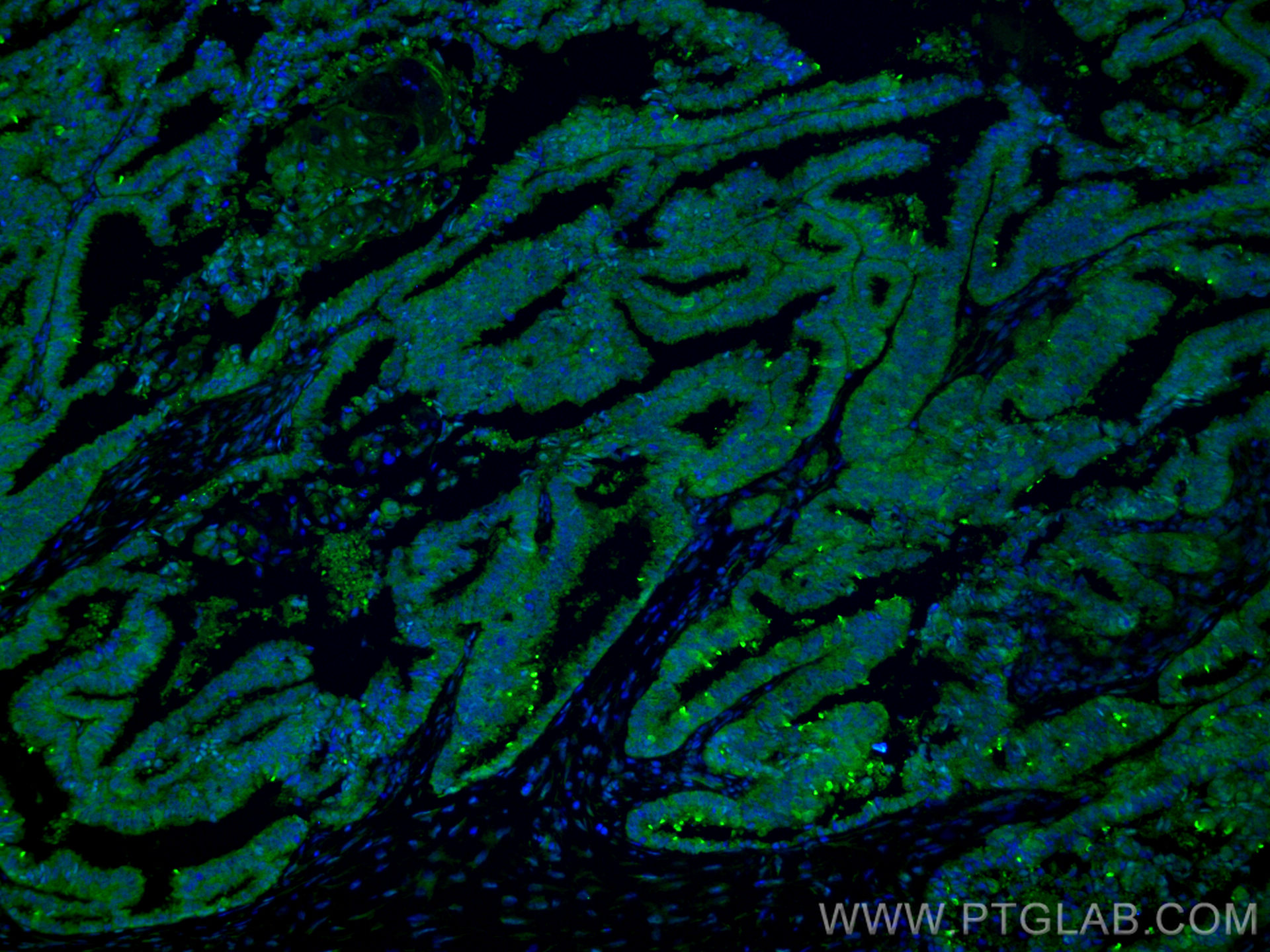 IF Staining of human ovary tumor using 66435-1-Ig (same clone as 66435-1-PBS)