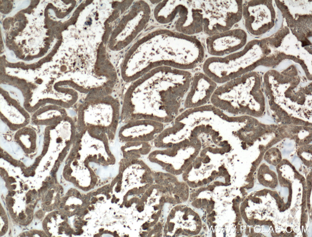 IHC staining of human ovary tumor using 66435-1-Ig (same clone as 66435-1-PBS)
