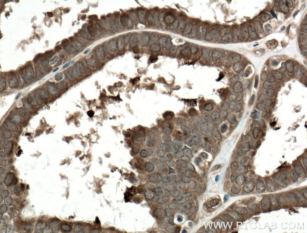IHC staining of human ovary tumor using 66435-1-Ig (same clone as 66435-1-PBS)