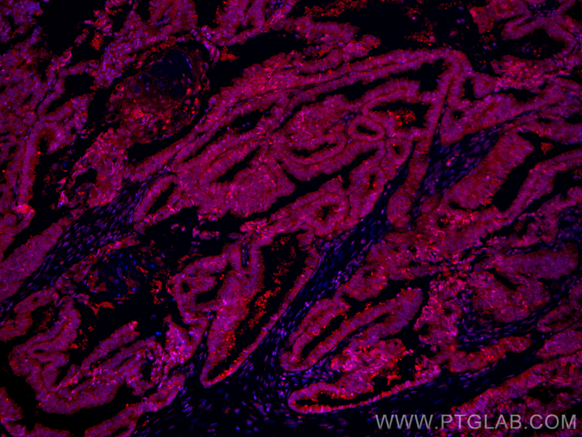 IF Staining of human ovary cancer using CL594-66435