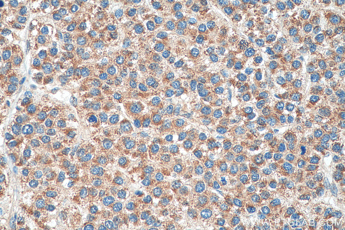 IHC staining of human liver cancer using 14874-1-AP