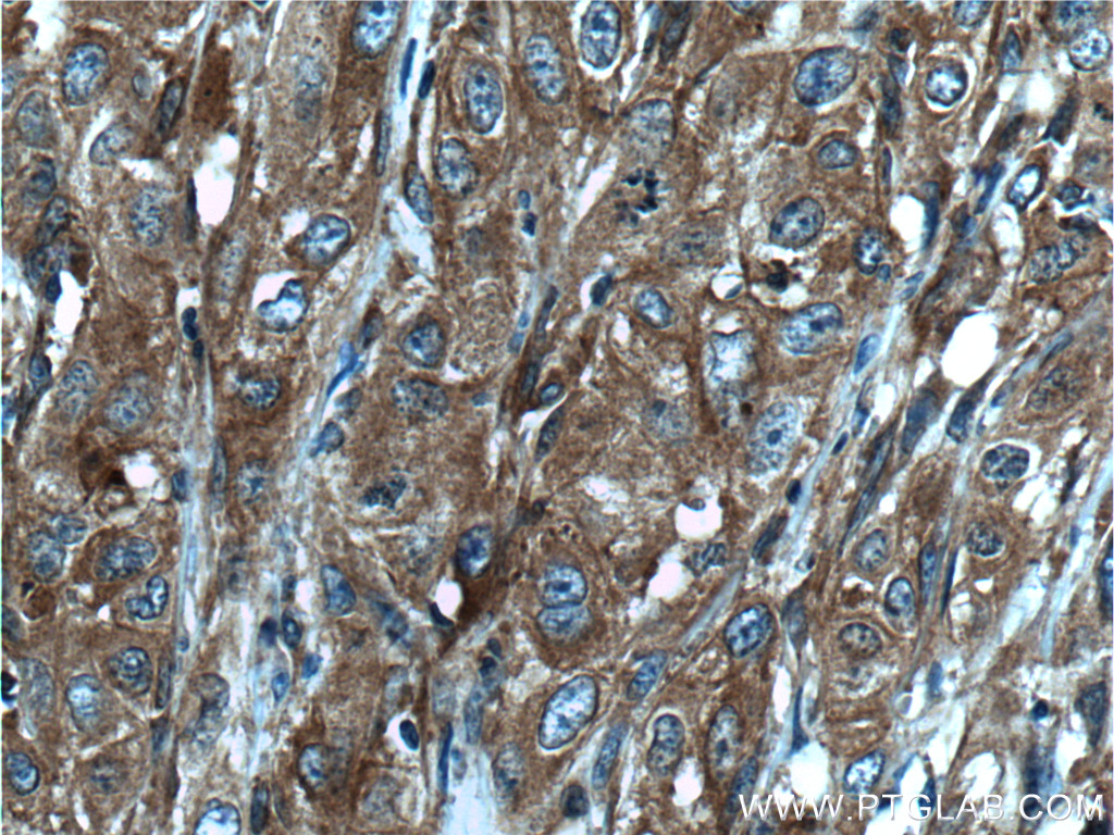 IHC staining of human cervical cancer using 14749-1-AP