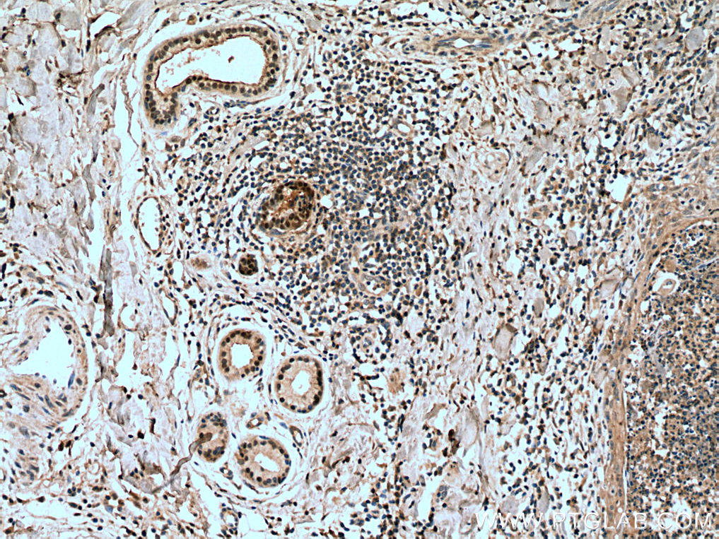 IHC staining of human skin cancer using 10119-1-AP