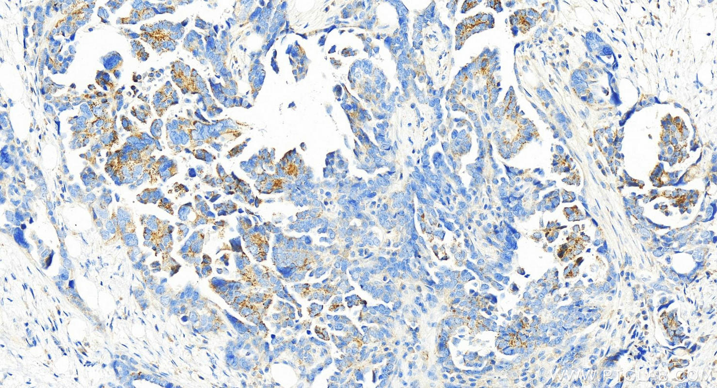 IHC staining of human ovary cancer using 13802-1-AP