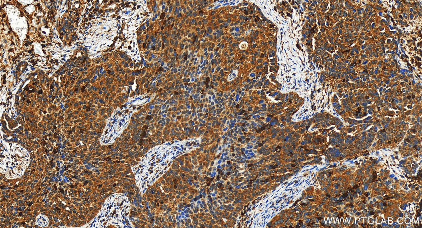 IHC staining of human ovary cancer using 31425-1-AP