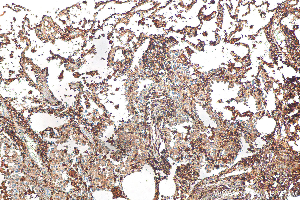 IHC staining of human lung cancer using 10781-1-AP (same clone as 10781-1-PBS)