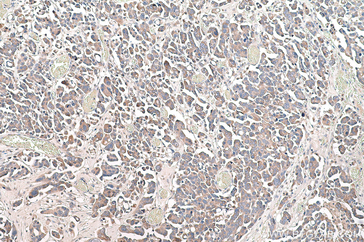 IHC staining of human colon cancer using 66351-1-Ig (same clone as 66351-1-PBS)