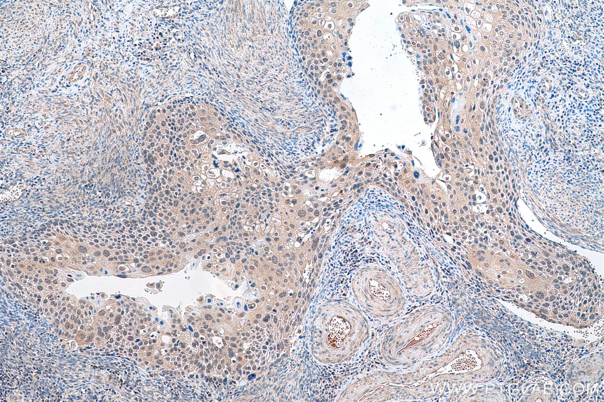 IHC staining of human cervical cancer using 66351-1-Ig (same clone as 66351-1-PBS)