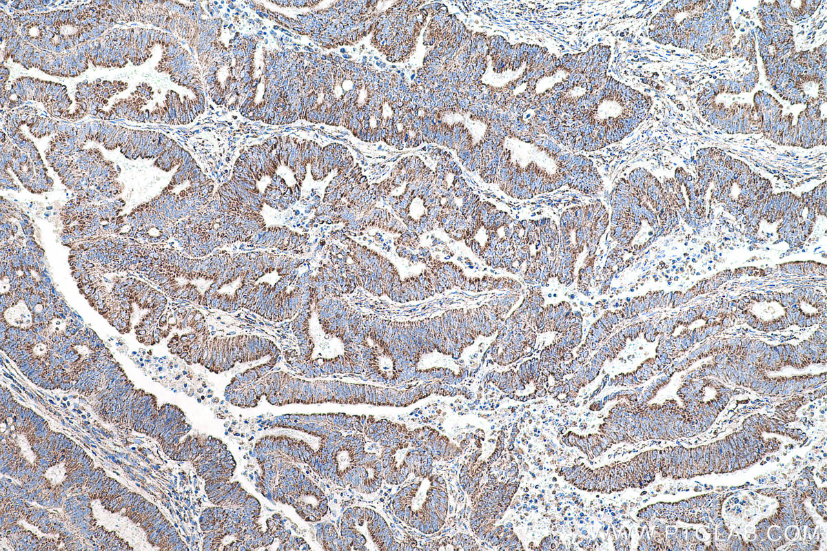 IHC staining of human colon cancer using 55070-1-AP