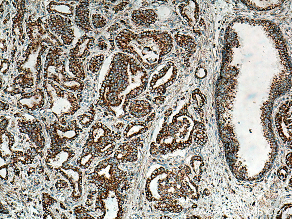 IHC staining of human prostate cancer using 11242-1-AP