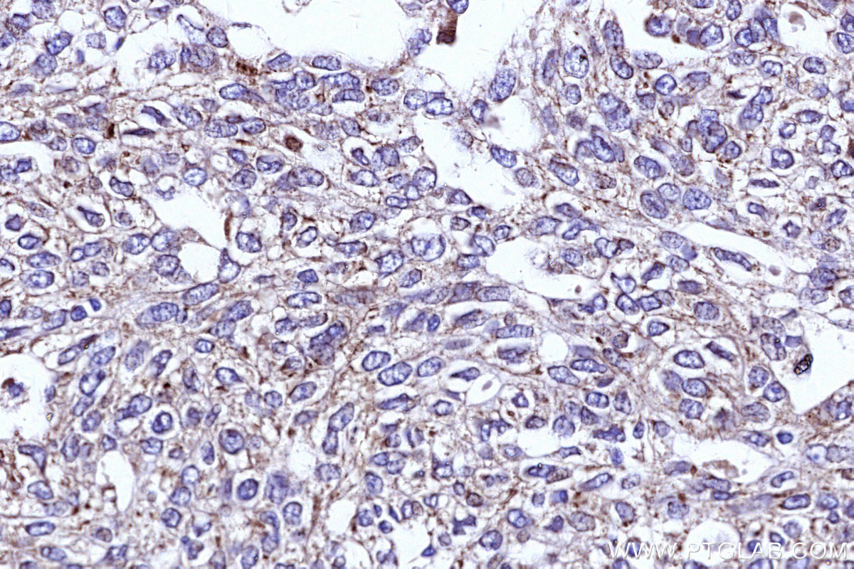 IHC staining of human ovary cancer using 19889-1-AP IHC staining of human ovary cancer using 19889-1-AP