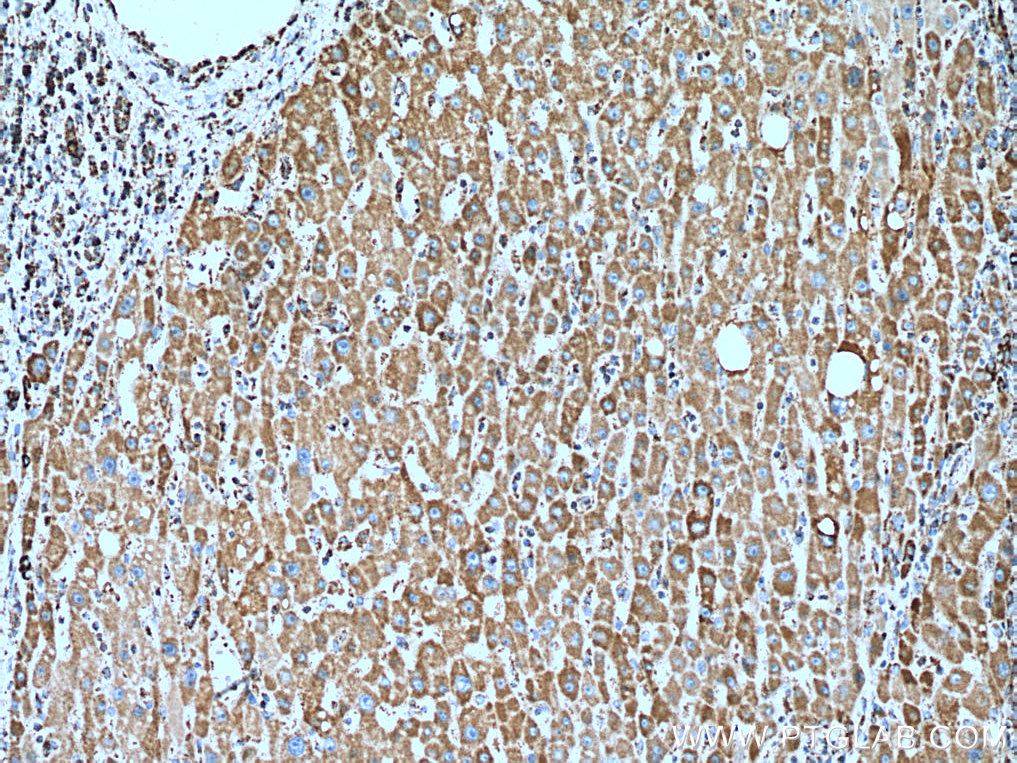 IHC staining of human liver cancer using 11418-2-AP