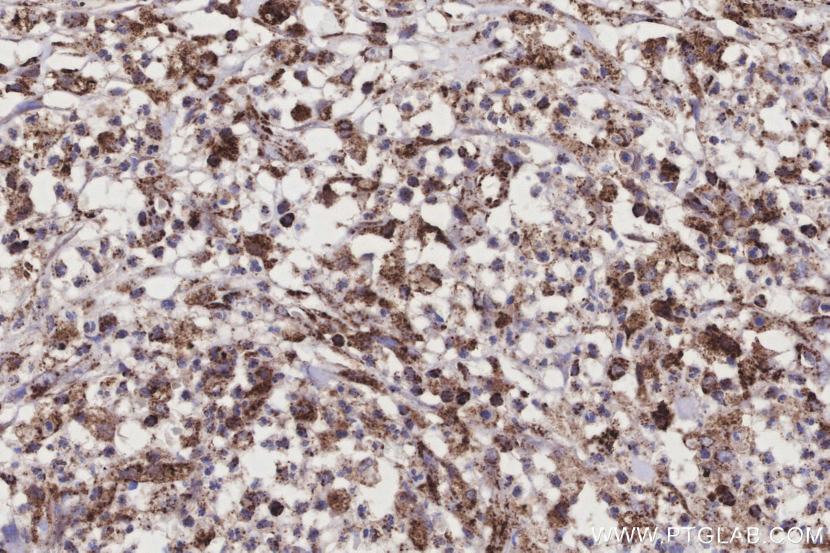 IHC staining of human colon cancer using 11460-1-AP IHC staining of human colon cancer using 11460-1-AP