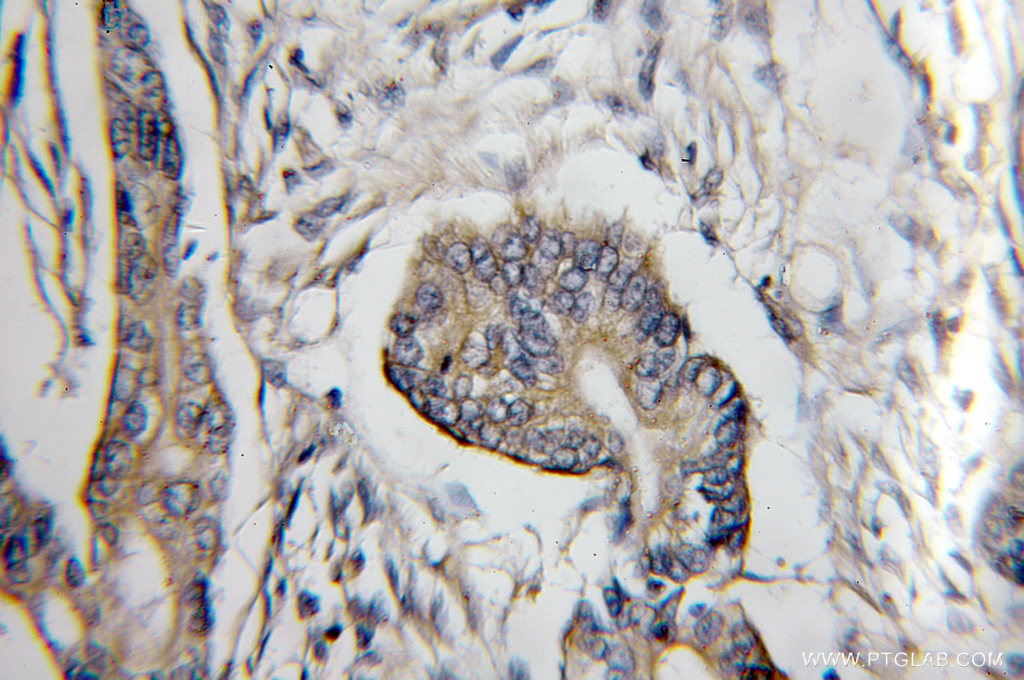 IHC staining of human pancreas cancer using 11429-2-AP