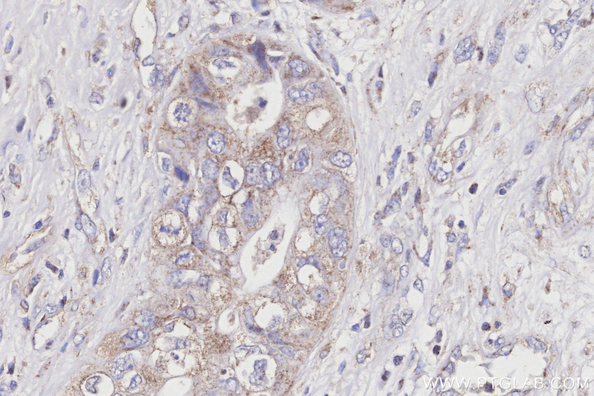 IHC staining of human pancreas cancer using 11411-2-AP IHC staining of human pancreas cancer using 11411-2-AP