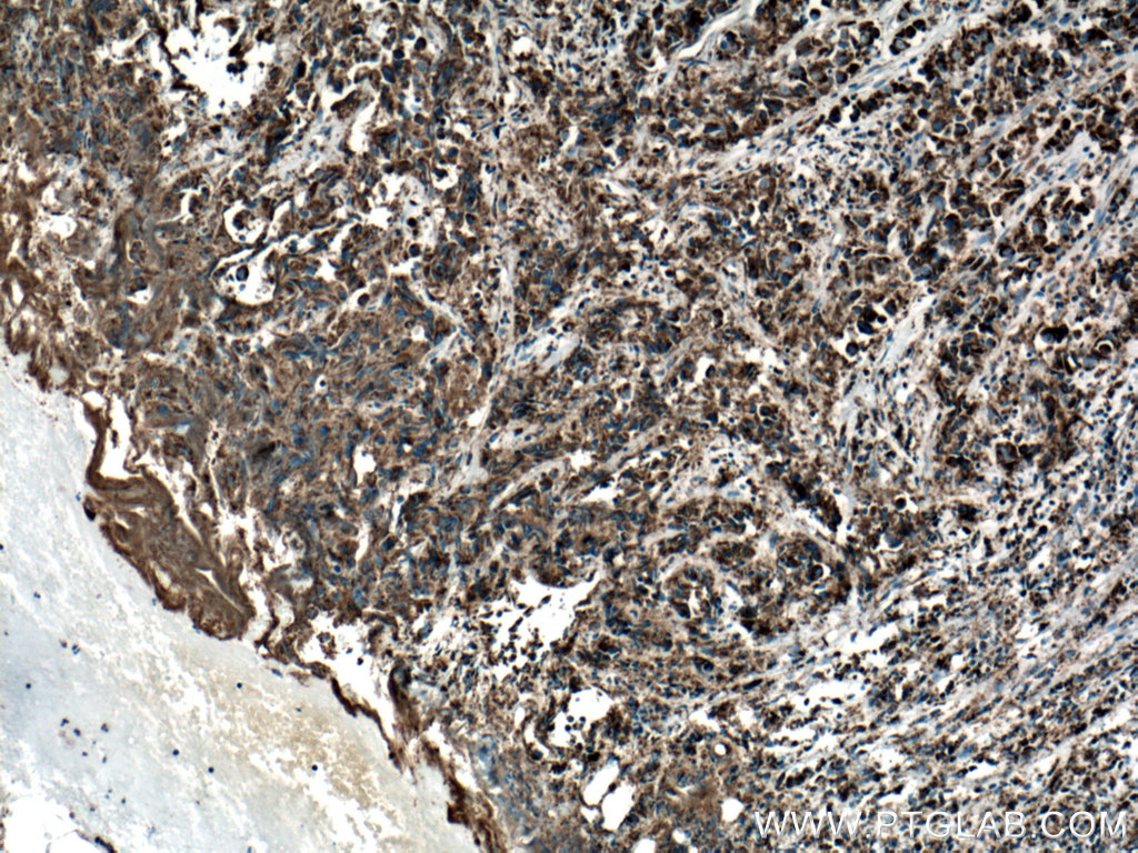 IHC staining of human prostate cancer using 66110-1-Ig (same clone as 66110-1-PBS)