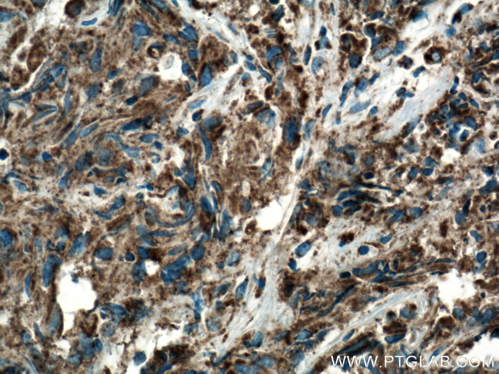 IHC staining of human prostate cancer using 66110-1-Ig (same clone as 66110-1-PBS)