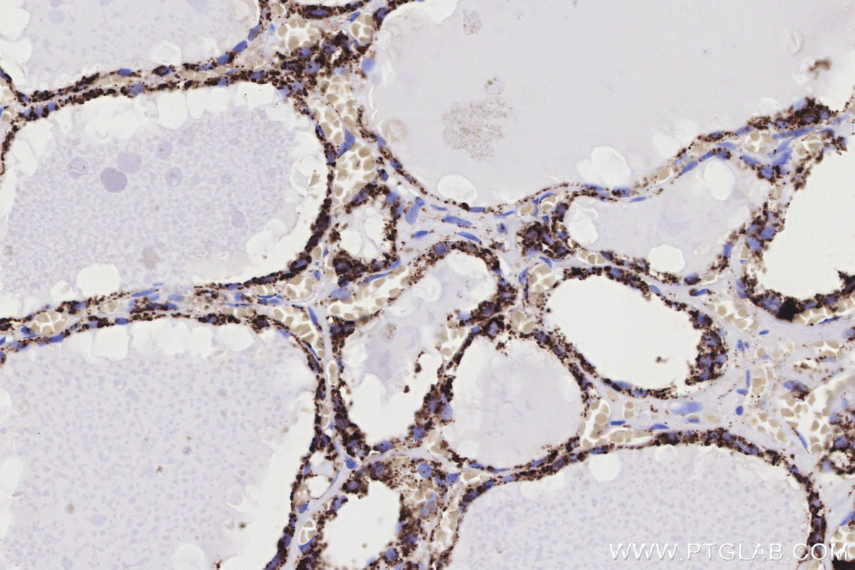 IHC staining of human thyroid cancer using 82916-1-RR IHC staining of human thyroid cancer using 82916-1-RR