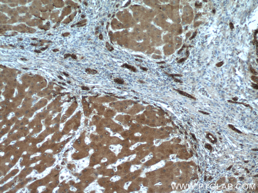 IHC staining of human hepatocirrhosis using 21131-1-AP