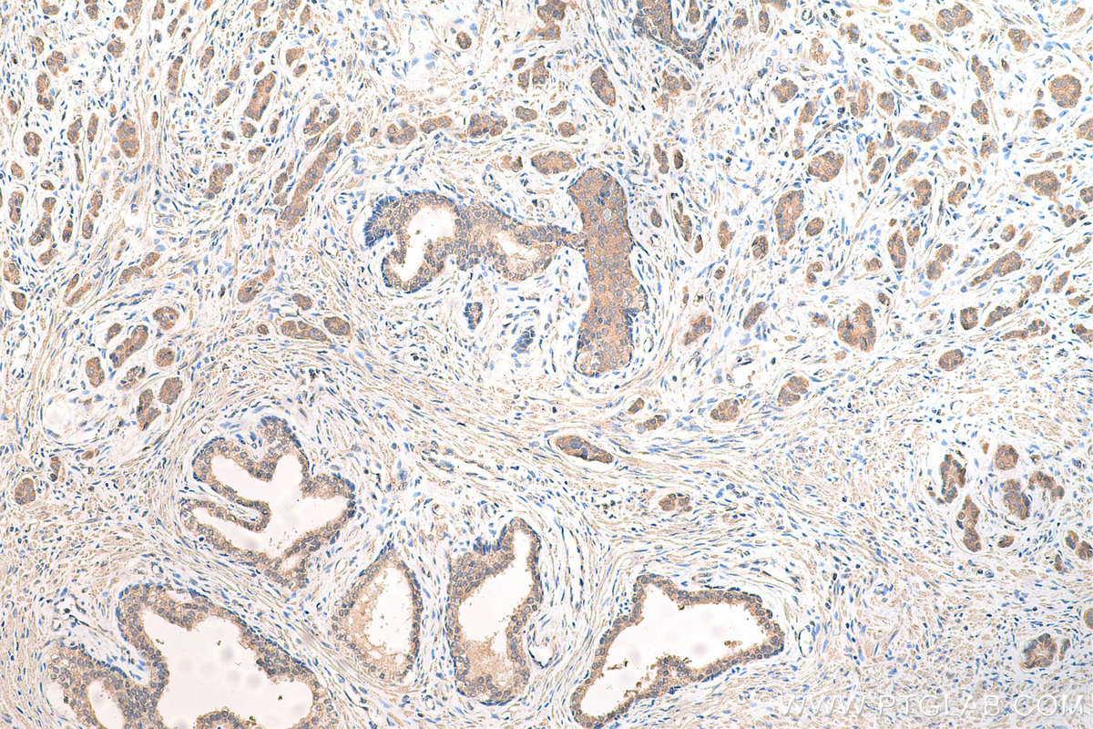 IHC staining of human prostate cancer using 12780-1-AP