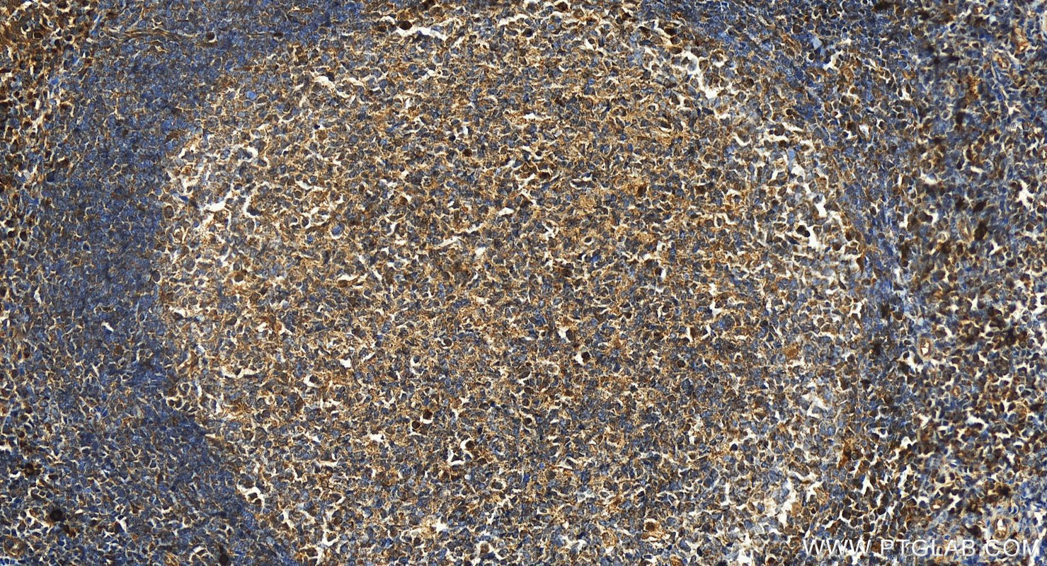 IHC staining of human tonsillitis using 16236-1-AP