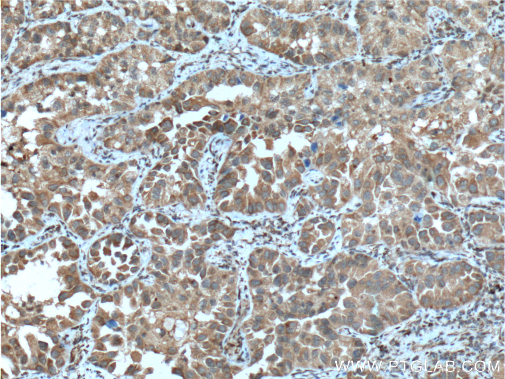 IHC staining of human lung cancer using 26824-1-AP