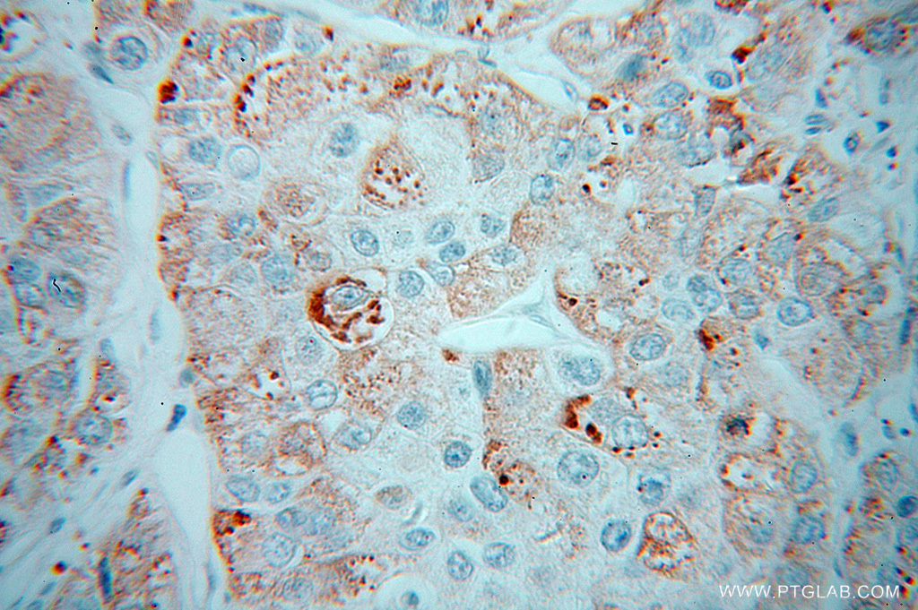 IHC staining of human liver cancer using 13385-1-AP