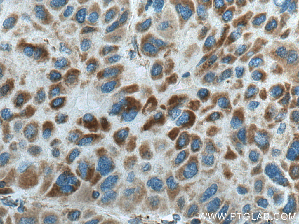 IHC staining of human liver cancer using 12211-1-AP
